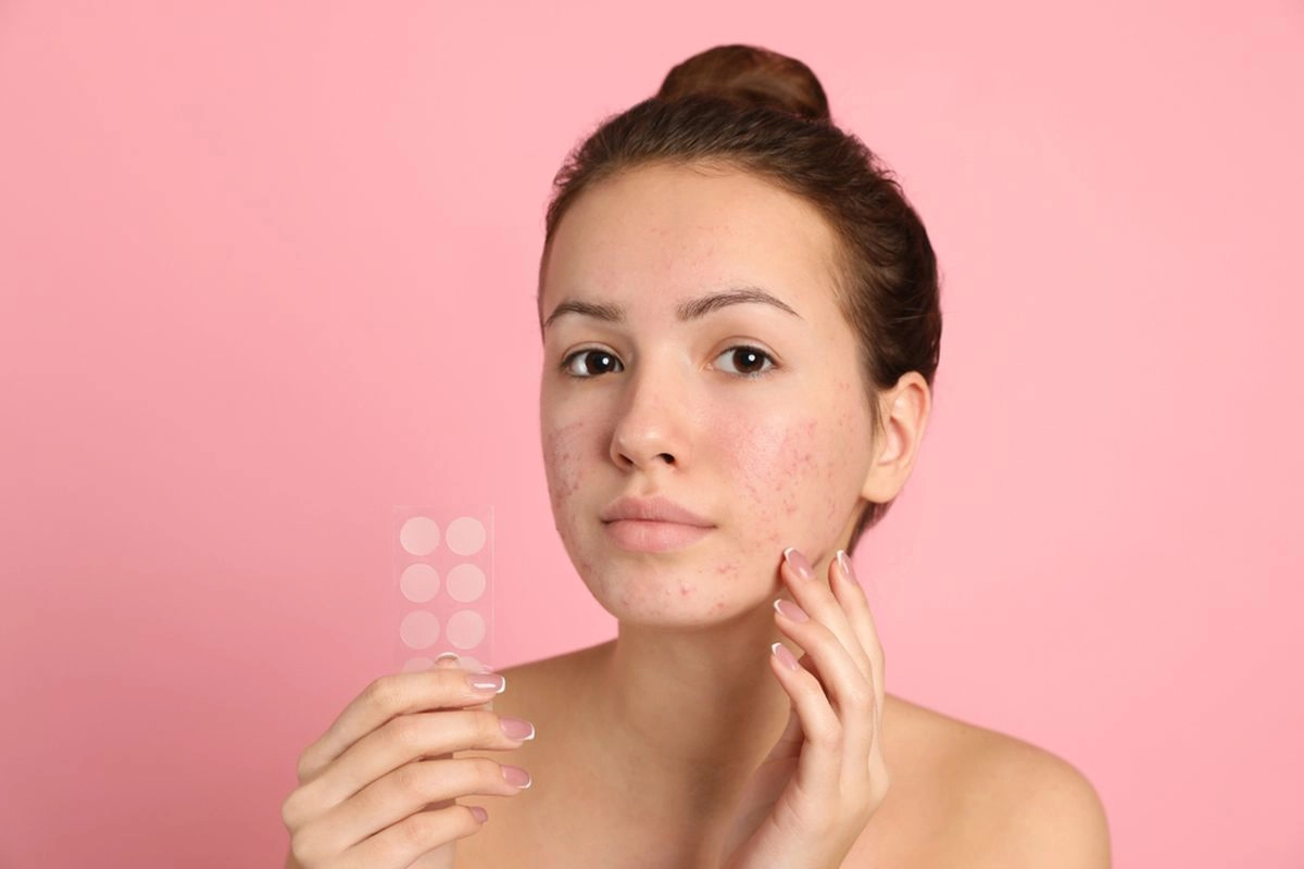 10 Cara Hilangkan Bekas Jerawat dengan Bahan Alami
