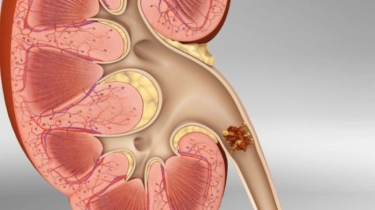 Batu Ginjal Bisa Berisiko Picu Penyakit Ginjal Kronik