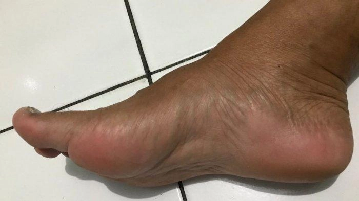 Jangan Dianggap Remeh, Ternyata Ini Alasan Kenapa Sering Keseleo