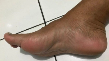 Jangan Dianggap Remeh, Ternyata Ini Alasan Kenapa Sering Keseleo