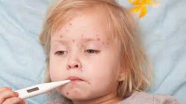 Wabah Campak yang Mengkhawatirkan Merebak di AS dan Inggris, Pejabat Kesehatan Waspada Tinggi