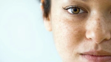 Flek Hitam di Wajah Bikin Tak Percaya Diri, Apakah Bisa Hilang? Begini Kata Dermatologist
