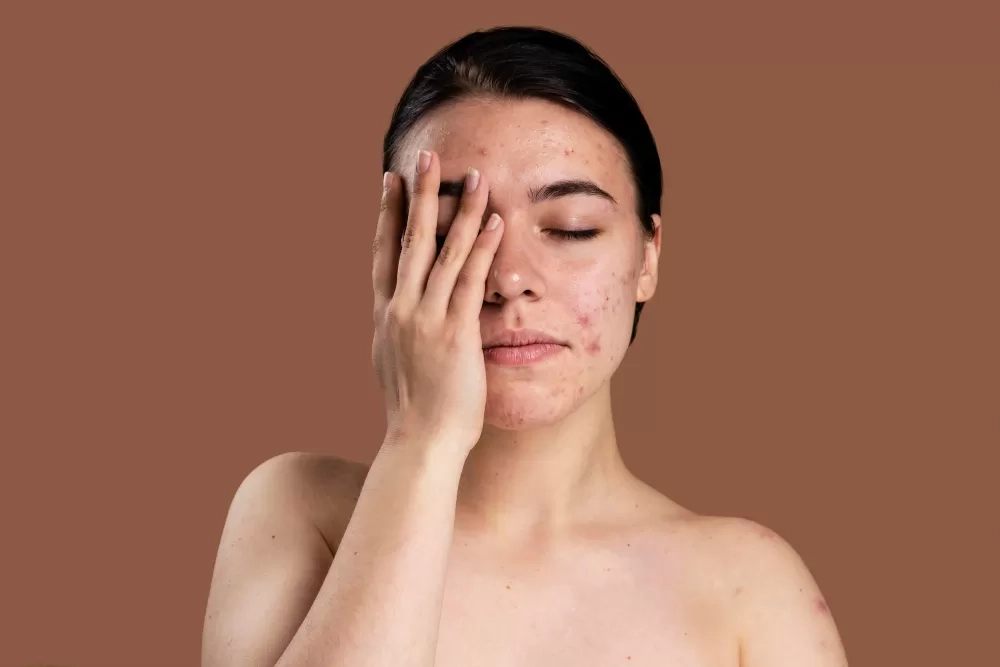 Kerap Disepelekan! 10 Penyebab Bruntusan di Dahi yang Bikin Gak Pede, Simak Tips Pencegahan dan Mengatasinya