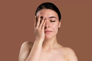 Kerap Disepelekan! 10 Penyebab Bruntusan di Dahi yang Bikin Gak Pede, Simak Tips Pencegahan dan Mengatasinya