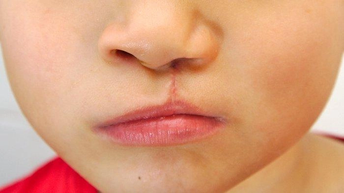 Kembalikan Senyum 60 Pasien Bibir Sumbing di NTT, Perusahaan Ini Gelar Operasi Gratis