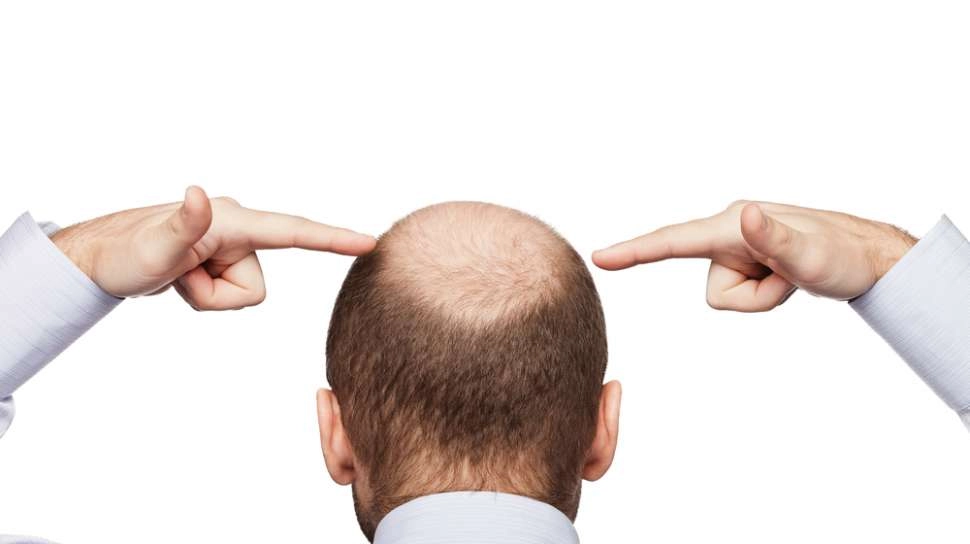 Rambut Rontok Jadi Masalah Utama yang Buat Laki-Laki Jadi Insecure, Memang Penyebabnya Apa Sih?