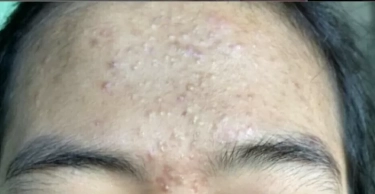 Perhatikan! Ternyata Ini Penyebab Jerawat di Dahi Kerap Muncul