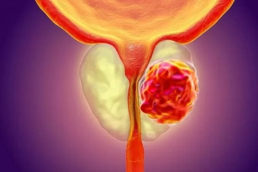 Kenali Penyebab dan Gejala Kanker Prostat Serta Cara Mengobatinya