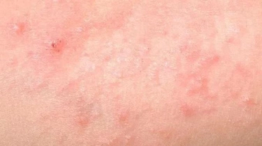 Ada Tiga Jenis Biang Keringat, Mana yang Pernah Kamu Alami? 