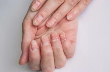 Leukonychia atau Bercak Putih pada Kuku, Ternyata Ini Penyebabnya