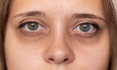 Yakin Krim Mata dapat Membantu Hilangkan Mata Panda? Cek Fakta dan Cara Alternatif untuk Mengatasi Dark Spot di Bawah Mata