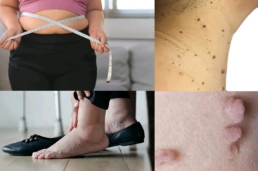 Awas, Tanda Anda Diabetes Bisa Dilihat dari Ciri Fisik Ini! Cek 7 Tandanya Sekarang Juga!