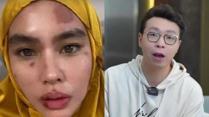 Soal Kartika Putri Alami Ruam di Muka dan Mulut, Richard Lee Tanggapi: Aku Percaya Ada Karma