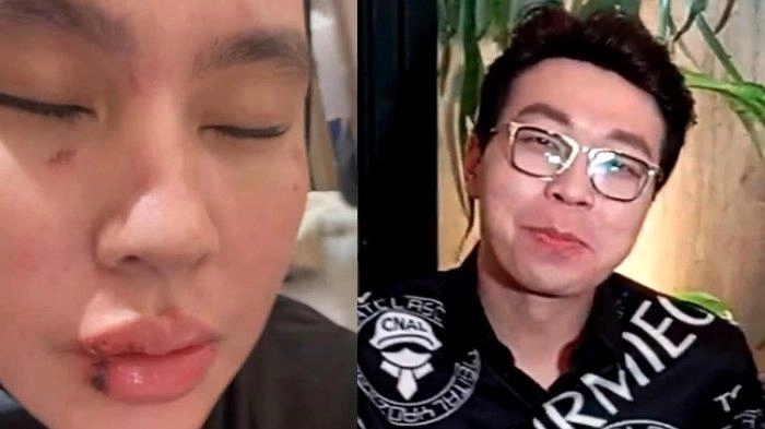 Richard Lee Sindir Kartika Putri yang Berobat ke Singapura: Kenapa Tidak Pilih Dokter Indonesia?