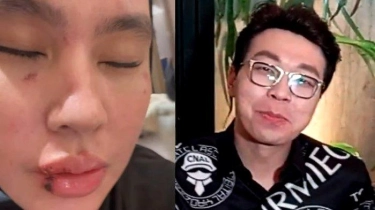 Richard Lee Sindir Kartika Putri yang Berobat ke Singapura: Kenapa Tidak Pilih Dokter Indonesia?