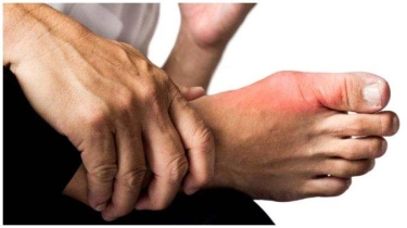 Cara Mengobati Asam Urat secara Alami Tanpa Obat-obatan, Ikuti 7 Tips Ini