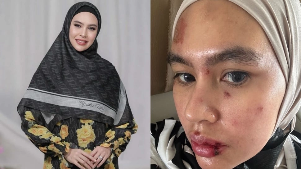 Kartika Putri Dinner Romantis Bareng Suami saat Wajahnya Masih Luka, Tas yang Ditenteng Harganya Tak Kaleng-Kaleng