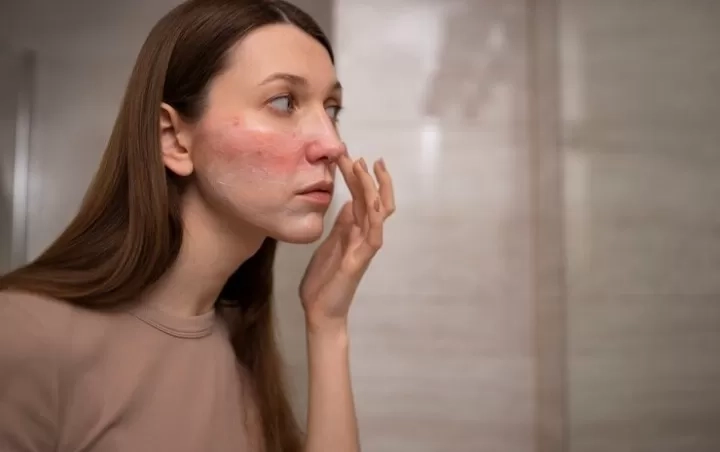 Hindari 8 Hal Berikut Pasca Chemical Peeling, Simak untuk Memperoleh Hasil yang Optimal