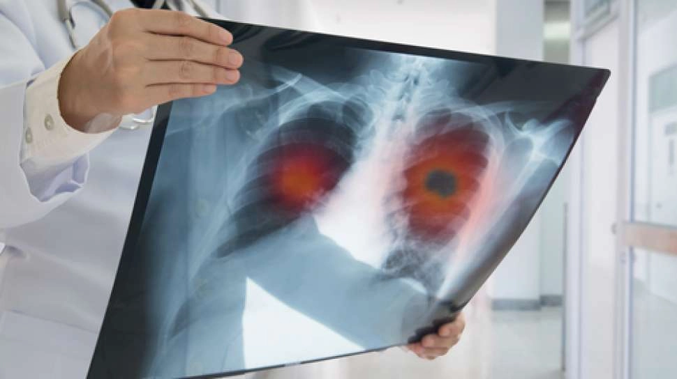 Obat Imunoterapi Serplulimab Tingkatkan Angka Harapan Hidup Kanker Paru Sel Kecil