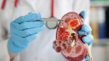 Aturan Diet untuk Orang dengan Gangguan Ginjal, Tak Boleh Konsumsi Protein? Ini Petunjuk Dokter Gizi