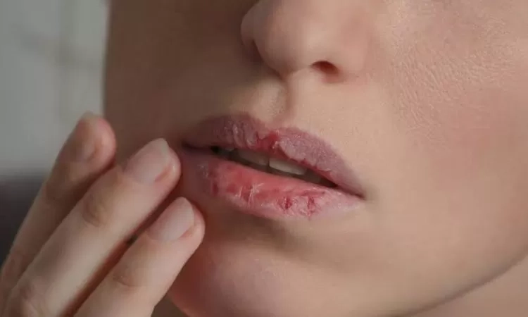 Sering Mengelupasi Bibir? Bisa Jadi Tanda Cemas, Begini Kata Dokter