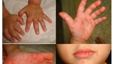 Sering Dialami Anak-anak Usia 7 Tahun ke Bawah, Begini Cara Membedakan Flu Singapura dan Flu Biasa