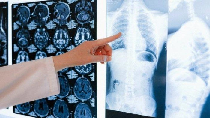 Kasus TB Alami Peningkatan Hingga 77 Persen di Indonesia