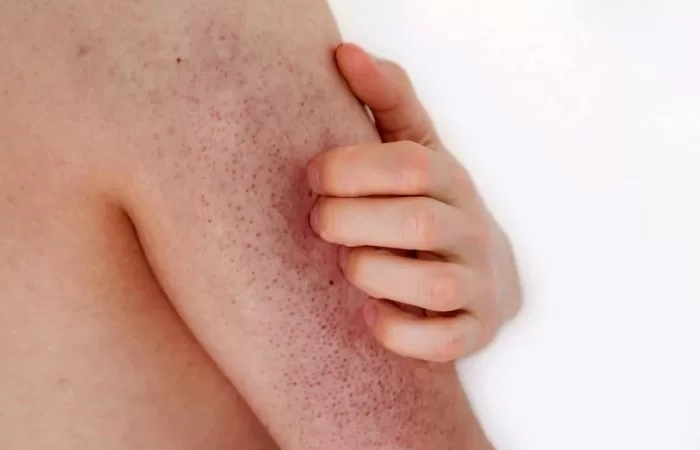 Cara Menghilangkan Penyakit Keratosis Pilaris dan Bisa Dilakukan Dirumahan