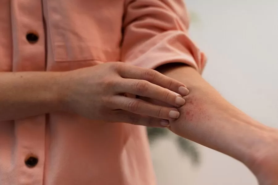 Mitos dan Fakta Penyakit Lupus, Berbahaya dan Menular?