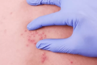 Perlu Diketahui! Berikut Jenis Virus Herpes Menyerang Manusia, Beserta Pencegahan dan Pengobatannya
