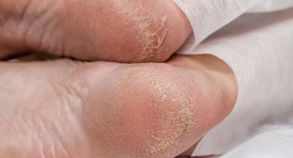 Simak! 6 Cara Mudah Mengatasi Tumit Kaki Kering dan Pecah-Pecah di Rumah