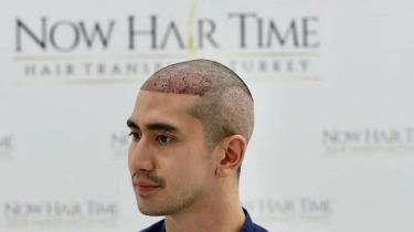 Banyak Dilakukan Artis Untuk Cegah Kebotakan, Ini Dos and Donts Sebelum dan Sesudah Transplantasi Rambut