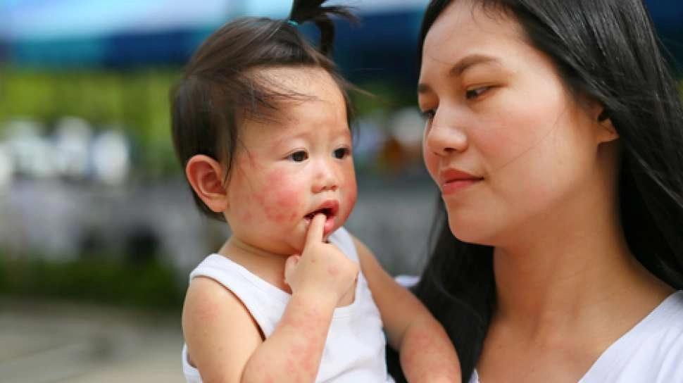 Ruam Kulit dan Diare pada Bayi? Waspadai Alergi Susu Sapi!