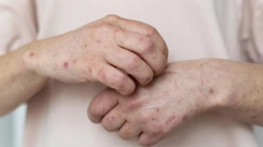 Jangan Sepelekan Cacar Air Pada Anak, Waspada Komplikasi Serius!