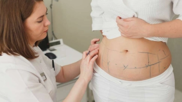 Bukan Buat Turunkan Berat Badan, Dokter Ungkap Operasi Sedot Lemak Aman Asalkan...