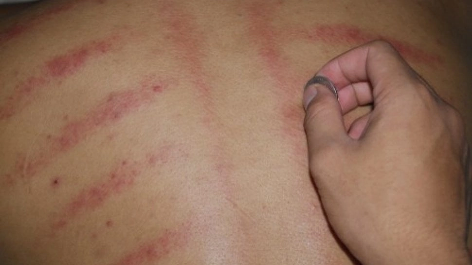 Cek Fakta: Kerokan di Sekitar Leher Bisa Memicu Stroke, Benarkah?
