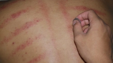 Cek Fakta: Kerokan di Sekitar Leher Bisa Memicu Stroke, Benarkah?