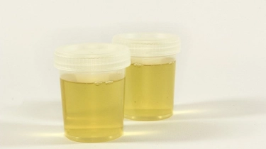 8 Warna Urine Jadi Penanda Baik Buruknya Kesehatan