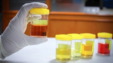 Warna Urine Tak Selalu Jadi Patokan Batu Ginjal, Ini Penjelasannya!