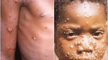 WHO Nyatakan Monkeypox sebagai Keadaan Darurat Kesehatan Masyarakat Global