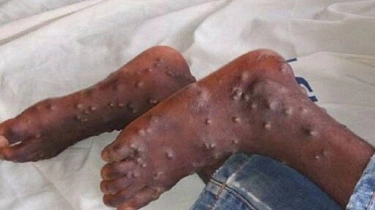 Geger! Jenis Monkeypox Berbahaya Pertama di Luar Afrika Ditemukan, 1 Warga Swedia Terinfeksi