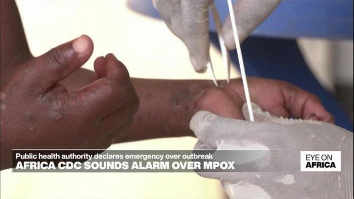 Sehari setelah Deklarasi WHO, Swedia Konfirmasi Kasus Pertama Strain Mpox Baru