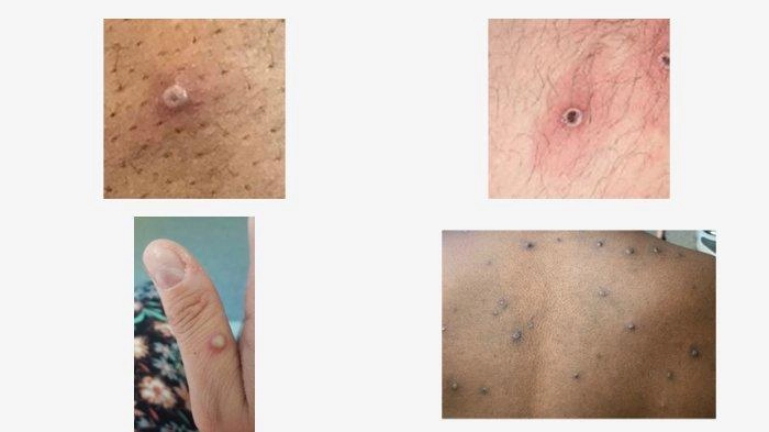 WHO Tetapkan Mpox Darurat Kesehatan Global, Kemenkes Beri Imbauan pada Pelaku Perjalanan