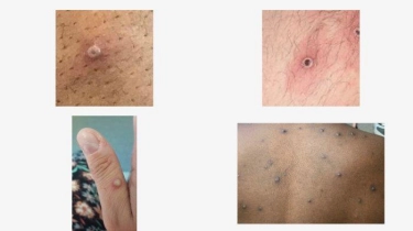 WHO Tetapkan Mpox Darurat Kesehatan Global, Kemenkes Beri Imbauan pada Pelaku Perjalanan