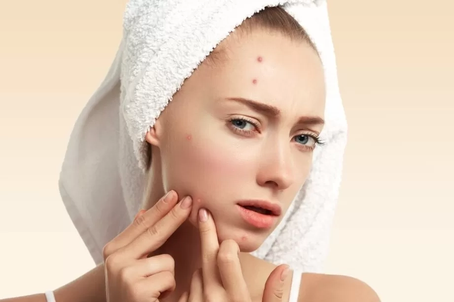 Rekomendasi Obat Jerawat dan Kisaran Harganya yang Bisa Dibeli di Apotek