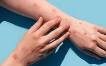 Waspada Monkeypox, Ini Tiga Vaksin Mpox yang Aman dan Teruji Digunakan