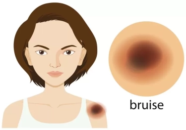 Sering Memar di Paha? Bukan Karena ‘Dicubit’ Setan, Berikut Penjelasan Ilmiahnya