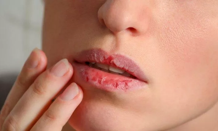 3 Langkah yang dapat Dilakukan untuk Mengelupas Kulit di Bibir yang Kering dan Cara Merawatnya
