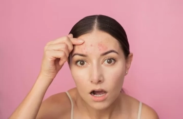 Benarkah Makanan Berminyak dan Gorengan Bisa Menyebabkan Jerawat? Begini Penjelasannya Menurut Ahli Dermatologi