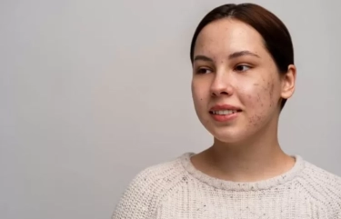 Terungkap! Bongkar 8 Fakta Tentang Jerawat, Stres Dapat Memperburuk Jerawat Tetapi Bukan Satu-Satunya Penyebab